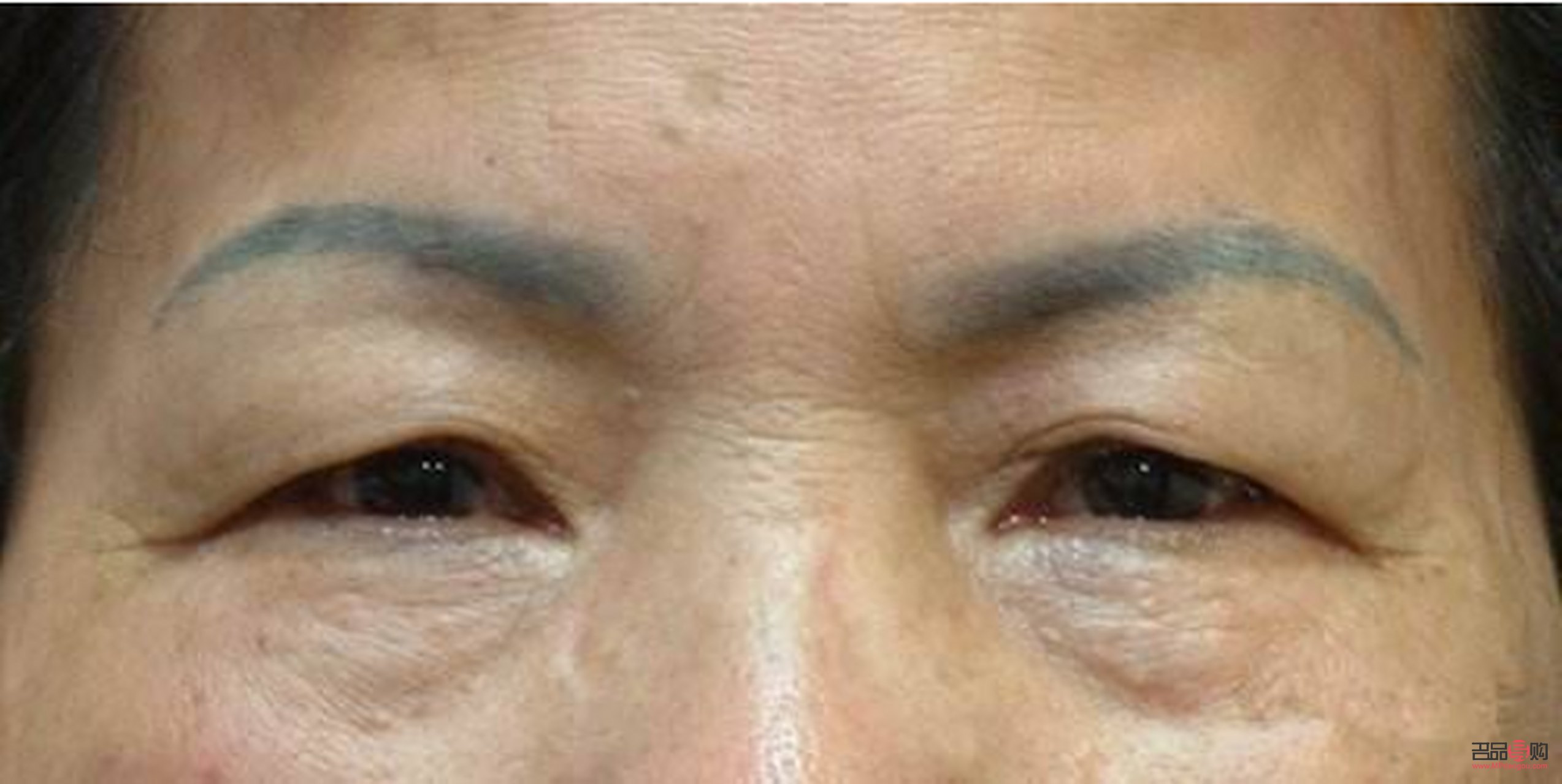 解決眼瞼松弛下垂的有效方法