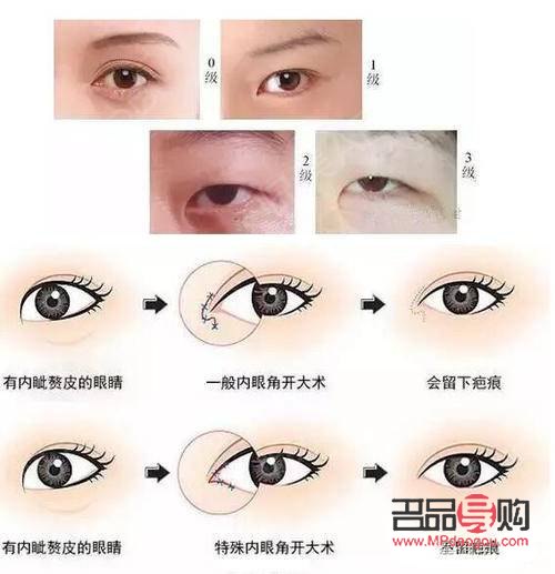 <h3>開眼角手術是否能讓眼睛變大？</h3>