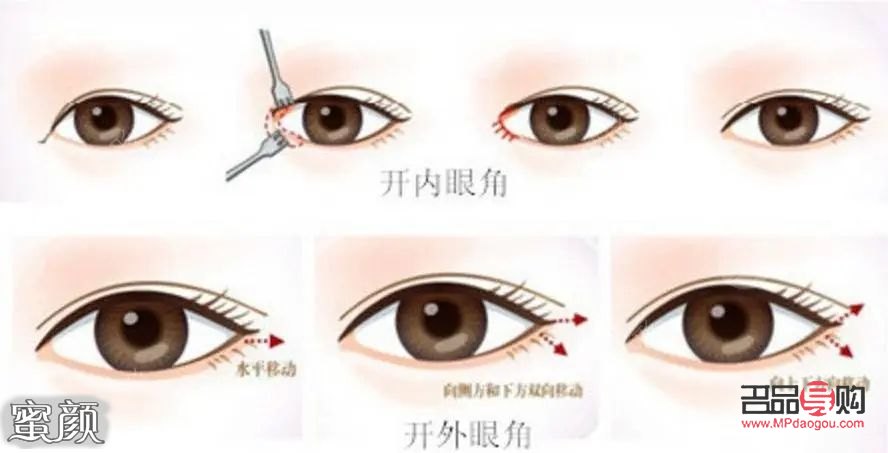 開眼角手術是否能讓眼睛變大？