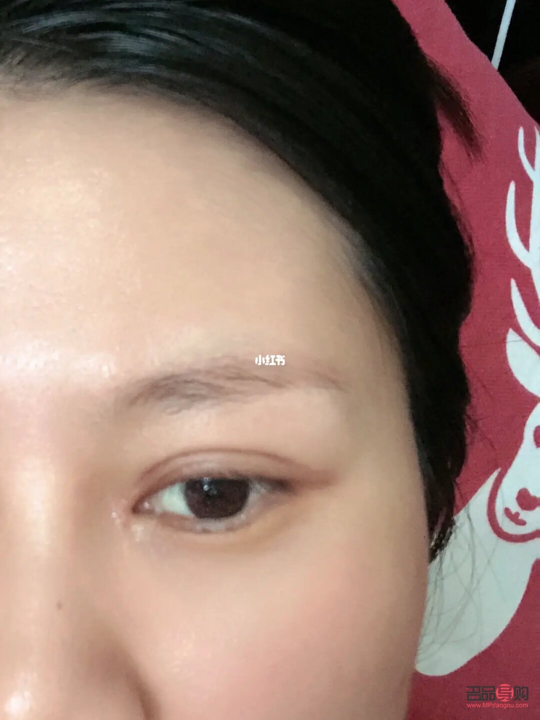割完雙眼皮眼皮有褶皺(割完雙眼皮眼皮有褶皺怎么辦)