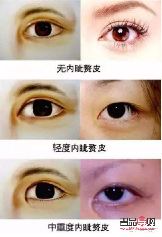 內眼角開太大會有什么影響(內眼角開太大會有什么影響嘛)