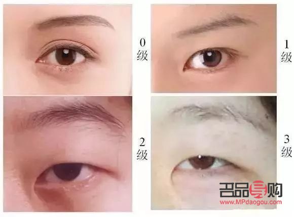 內眼角開太大會有什么影響(內眼角開太大會有什么影響嘛)
