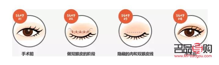 雙眼皮翹睫手術原理詳解
