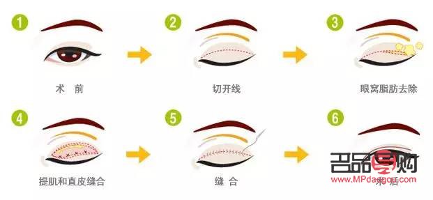 雙眼皮翹睫手術原理詳解