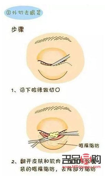 <h3>臥蠶與眼袋的區別詳解——圖解對照，一目了然</h3>