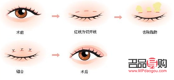 肉眼泡做雙眼皮手術是否需要抽脂？