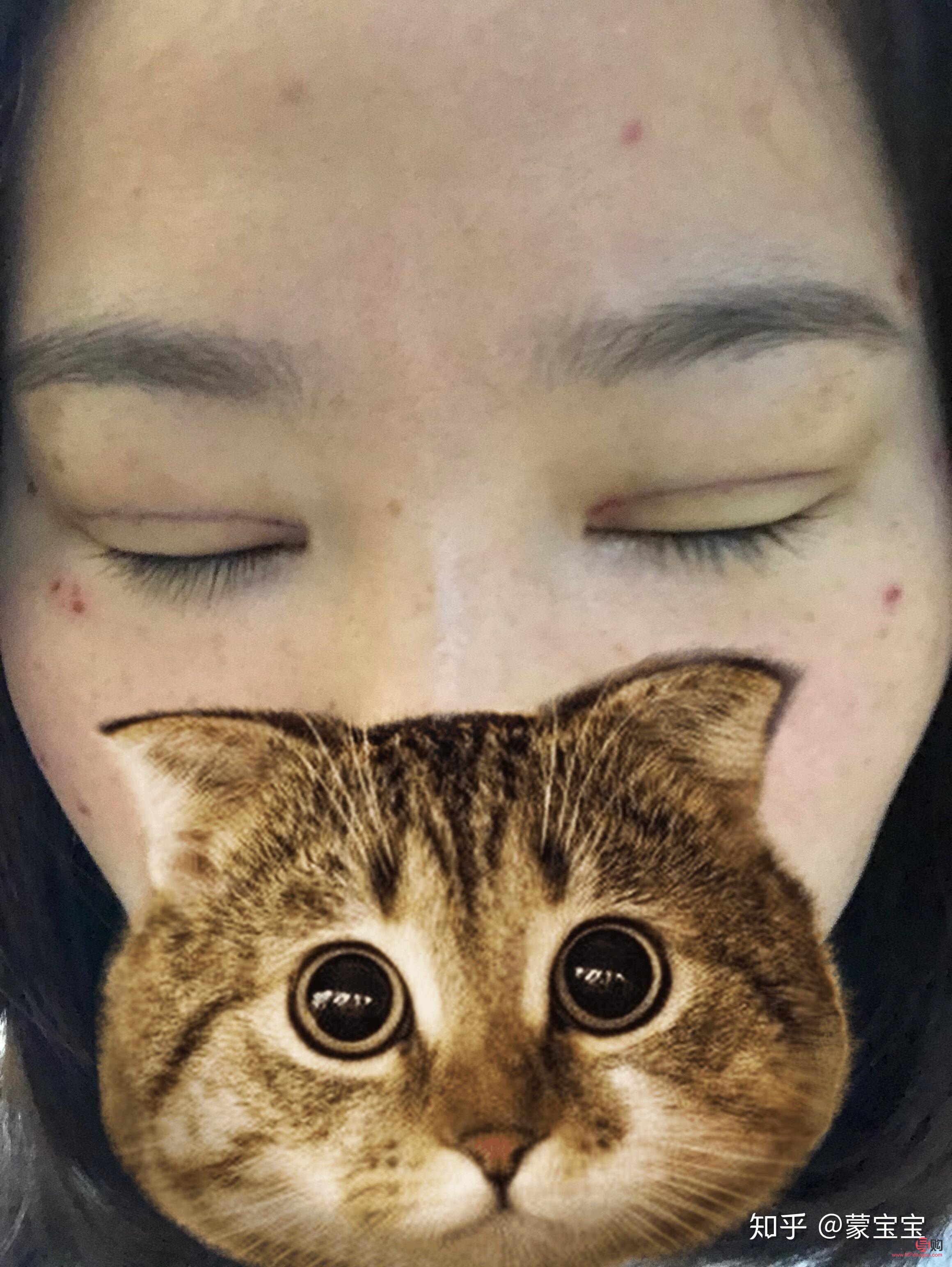 40歲做埋線雙眼皮，效果能維持多久？