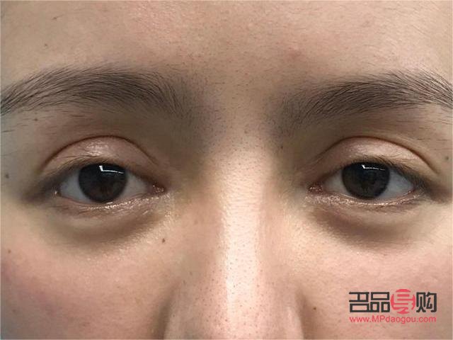 雙眼皮老了下垂圖片(雙眼皮老了會塌下來嗎)