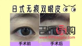 日式無痕雙眼皮是什么原理(日式無痕雙眼皮是什么原理做的)