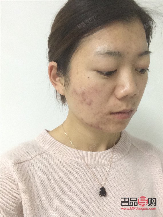 去美容院清痘好嗎(去美容院清痘好嗎女生)