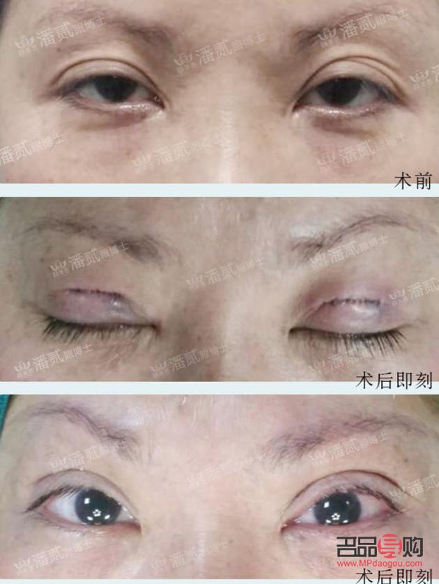 雙眼皮下垂是什么原因?qū)е碌?雙眼皮下垂是什么原因?qū)е碌哪?
