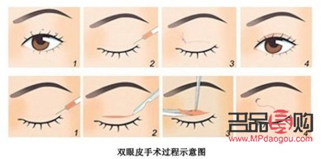 割雙眼皮對(duì)以后好嗎(割雙眼皮對(duì)以后有什么影響嗎)