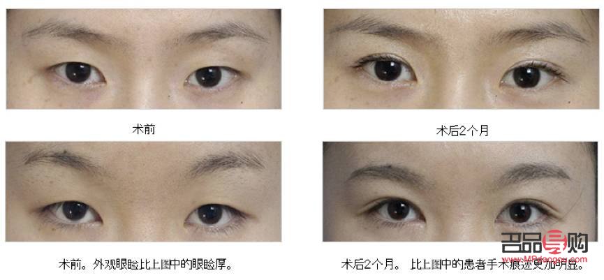 割雙眼皮對(duì)以后好嗎(割雙眼皮對(duì)以后有什么影響嗎)