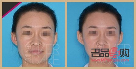 瘦臉針美容多少錢(瘦臉針美容多少錢一次)