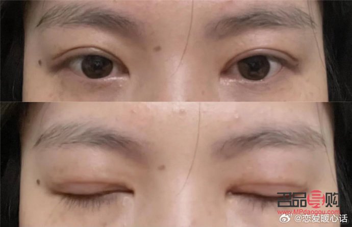 雙眼皮寬改窄風險大嗎(雙眼皮寬改窄風險大嗎圖片)