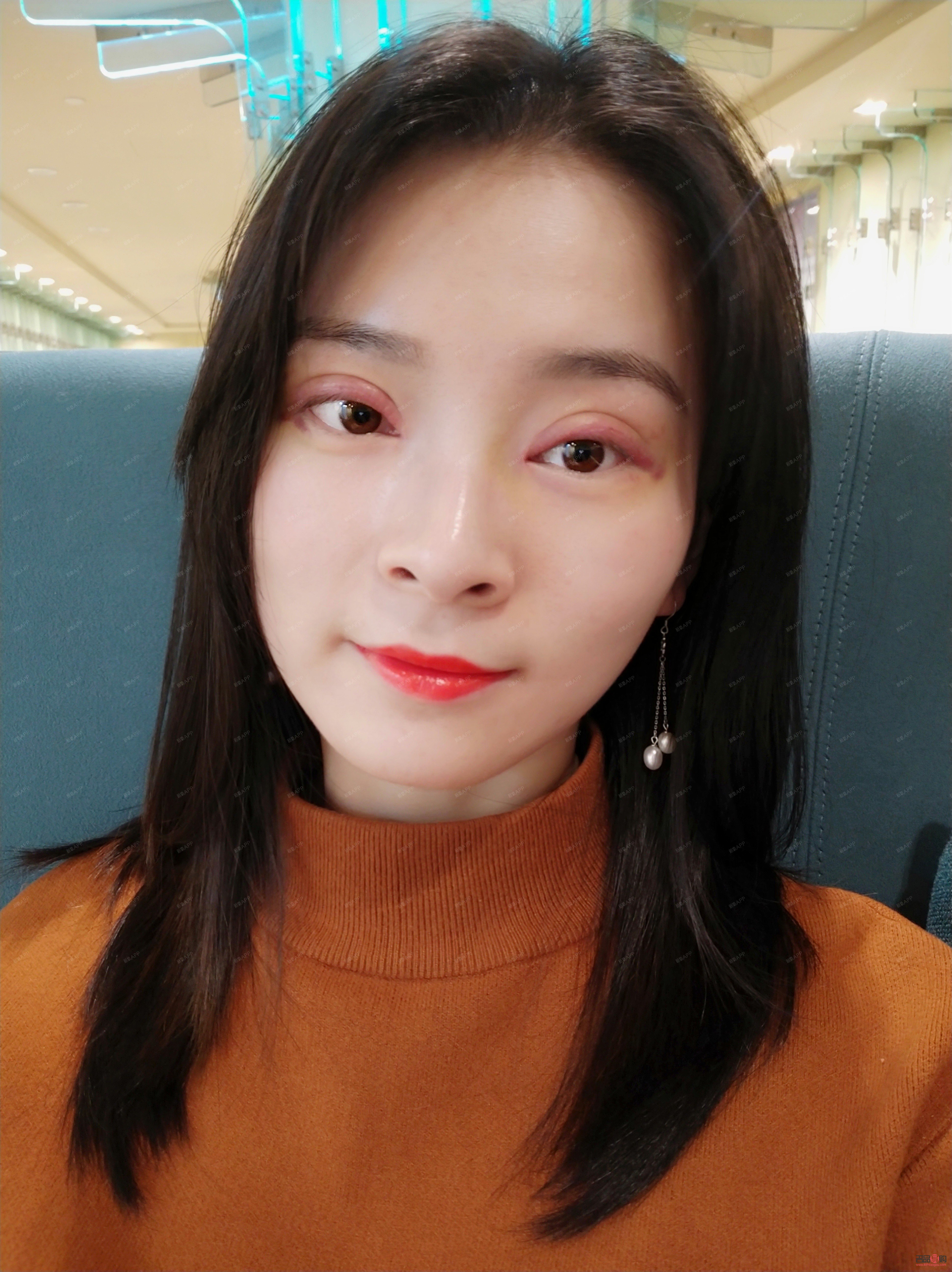 大眼綜合的恢復過程(大眼綜合的恢復過程是什么)