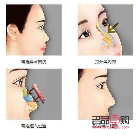美容隆鼻價(jià)格探究：了解隆鼻手術(shù)的費(fèi)用與價(jià)值