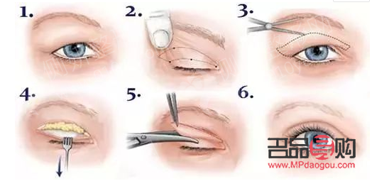 <h3>開眼角與雙眼皮手術費用詳解</h3>