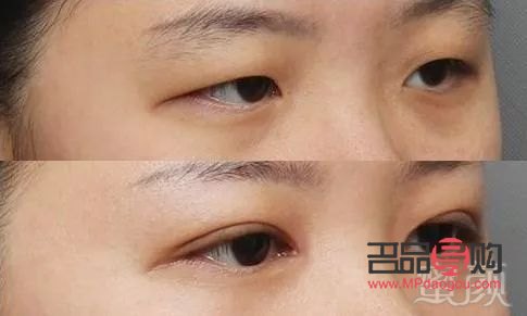 內雙腫眼泡適合做哪種雙眼皮手術(內雙腫眼泡適合做哪種雙眼皮手術多少錢)