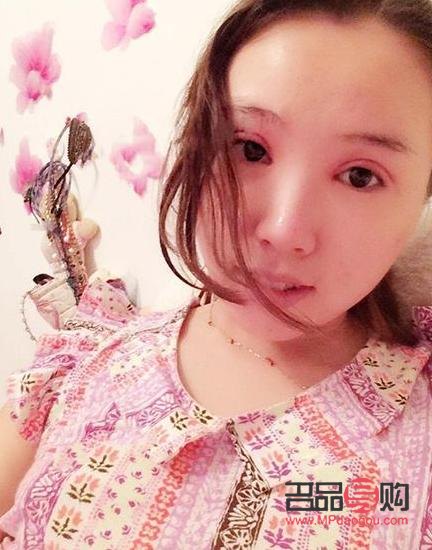 全切雙眼皮手術后的消腫之路