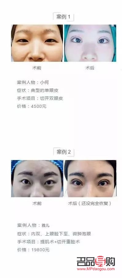 <h3>全切雙眼皮與半切雙眼皮：效果對比與選擇指南</h3>