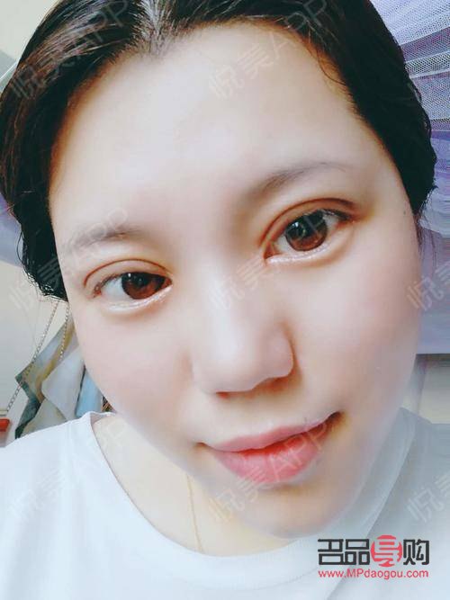 割雙眼皮需要多久的時間做完(割雙眼皮需要多久的時間做完手術(shù))