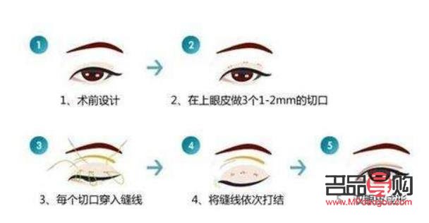 現在做雙眼皮大概要多少錢(雙眼皮技術不開刀不埋線)