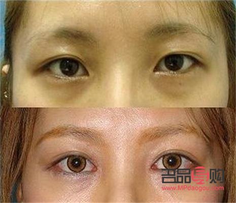 雙眼皮大小眼修復(fù)方法詳解