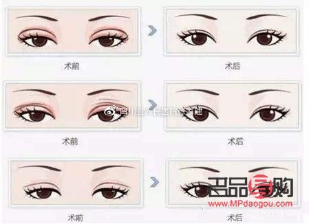 做雙眼皮手術大概需要多久(做雙眼皮手術大概需要多久時間)