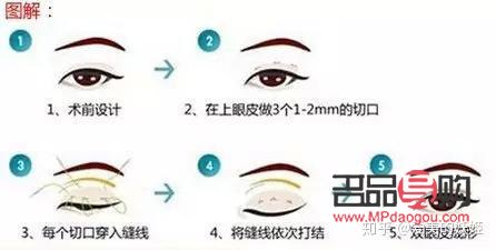 做雙眼皮手術大概需要多久(做雙眼皮手術大概需要多久時間)