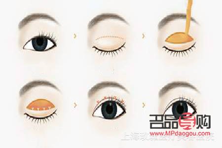 做雙眼皮手術(shù)大概需要多久(做雙眼皮手術(shù)大概需要多久時(shí)間)