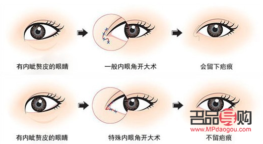 開眼角手術要多少錢(開眼角手術要多少錢?)