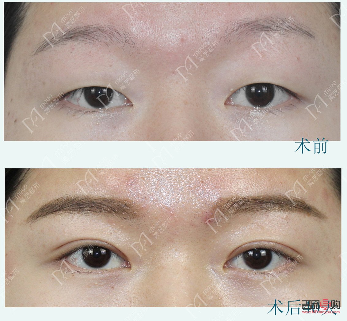 提肌無力雙眼皮手術(shù)費(fèi)用及注意事項(xiàng)
