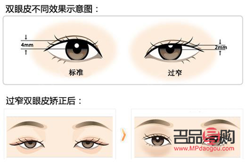 雙眼皮美學：哪款雙眼皮款式最受青睞？