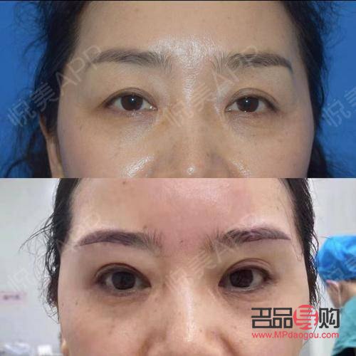 雙眼皮上眼皮松弛下垂怎么辦？專業(yè)解決方案與日常護(hù)理指南