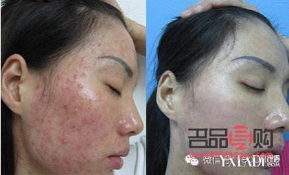 <h3>美容院清痘有用嗎？專業解析與效果評估</h3>
