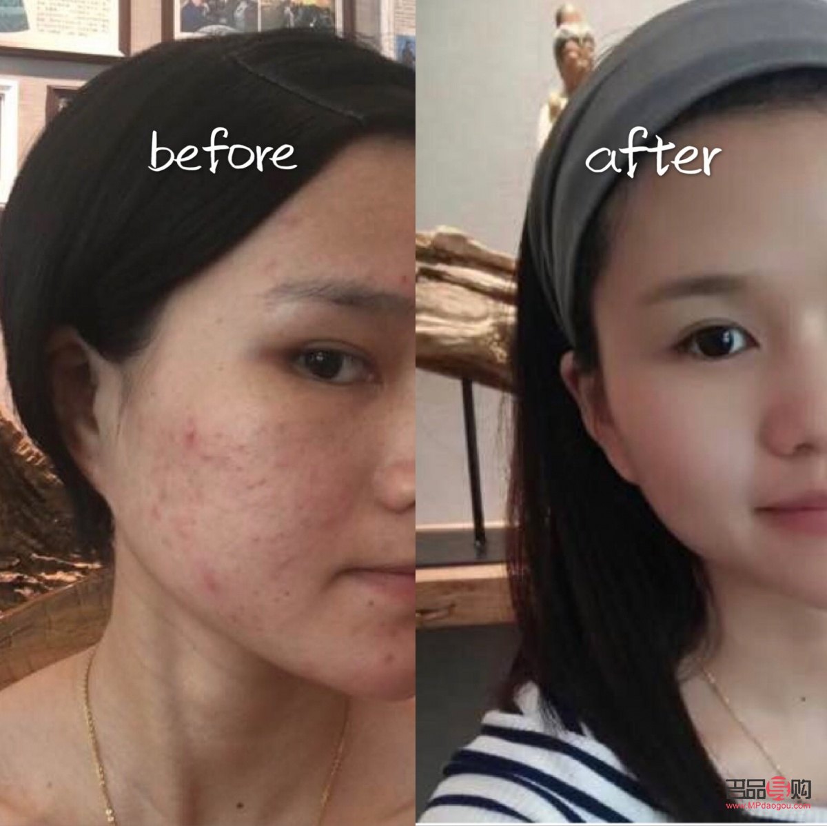 <h3>美容院清痘有用嗎？專業解析與效果評估</h3>