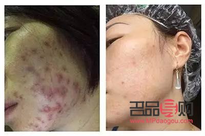 美容院清痘有用嗎？專業解析與效果評估
