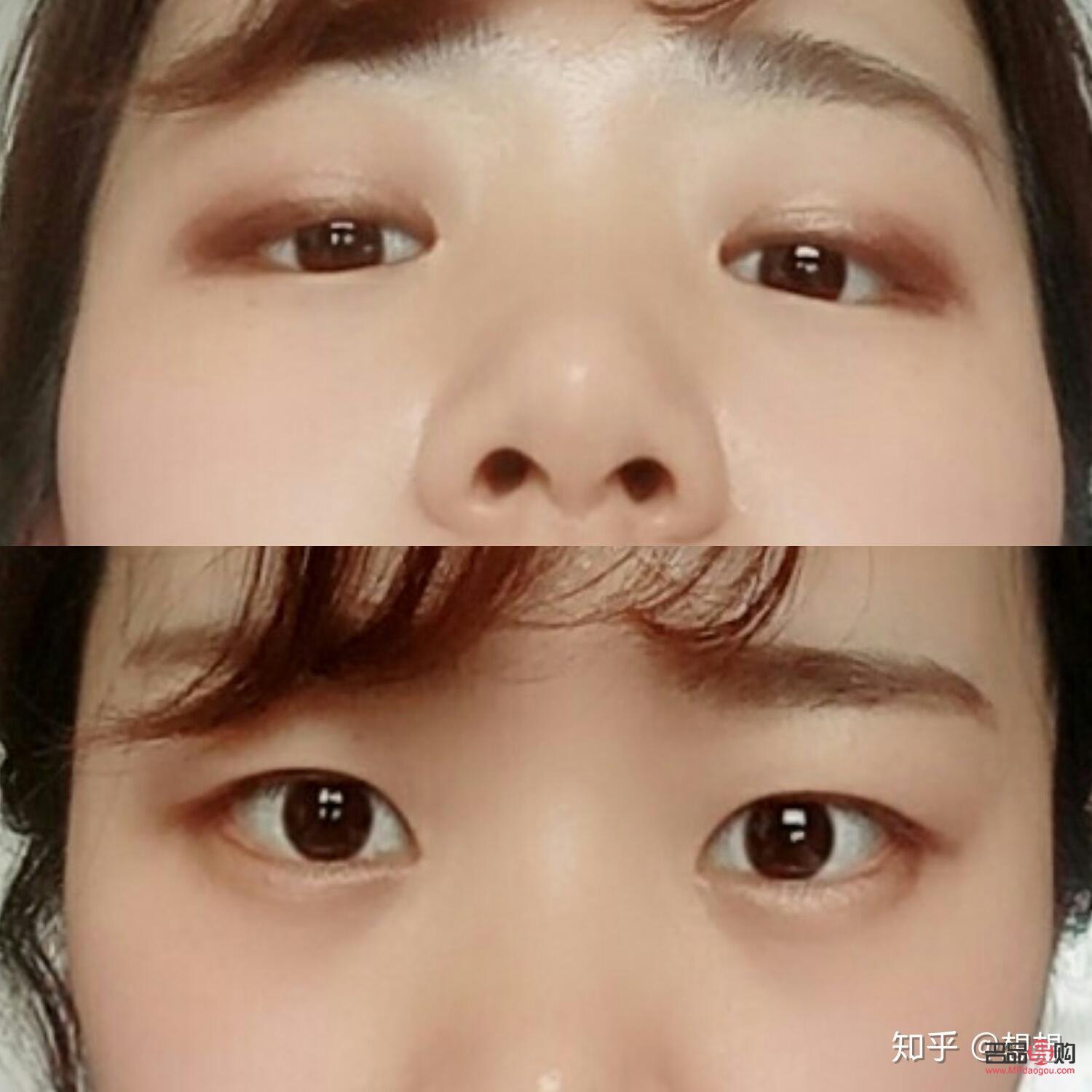 后天腫泡眼自我改善指南