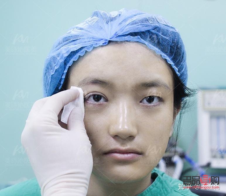 天生腫眼泡不手術，如何有效改善？