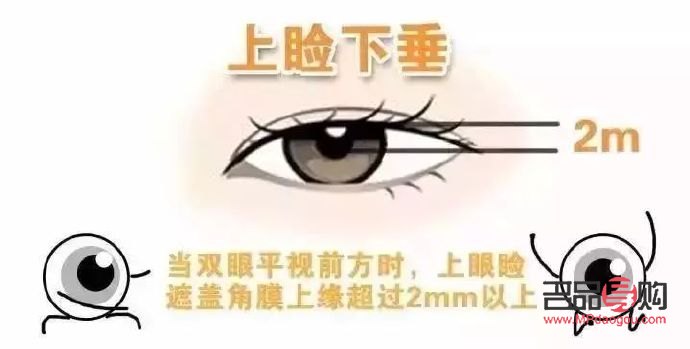 眼皮松弛下垂做手術多少錢啊(眼皮松弛下垂做手術多少錢啊)