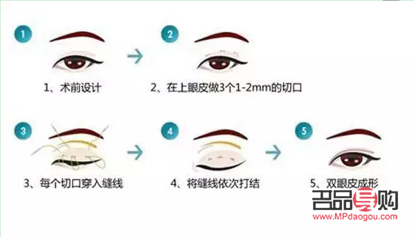 <h3>開眼角割雙眼皮手術時間詳解</h3>