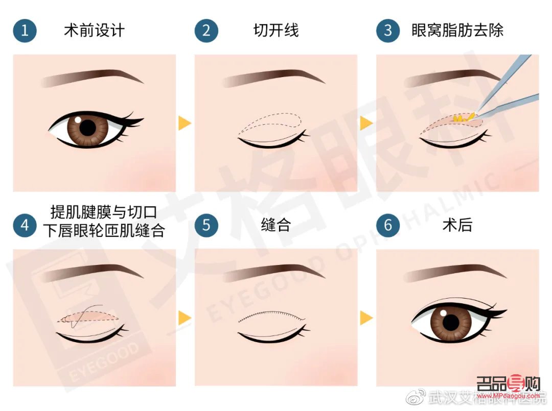 開眼角割雙眼皮手術時間詳解