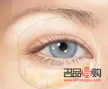 <h3>割眼袋好嗎？了解眼袋手術及其利弊</h3>