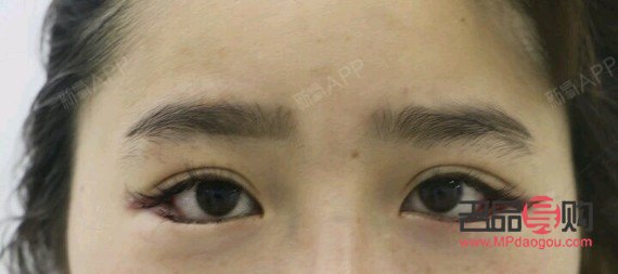 <h3>眼睛一高一低矯正手術費用及注意事項</h3>