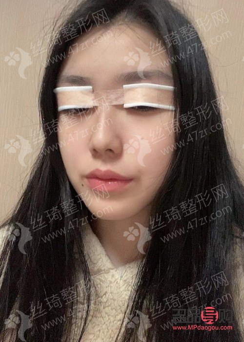 眼睛一高一低矯正手術費用及注意事項