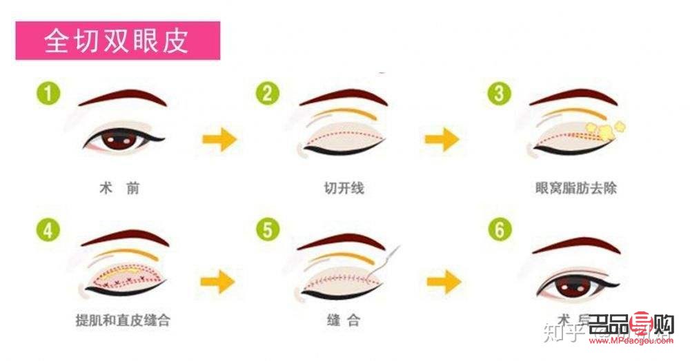 埋眼線與割雙眼皮：哪個更適合你？