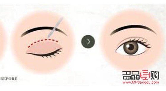 <h3>納米雙眼皮與埋線的區別詳解</h3>