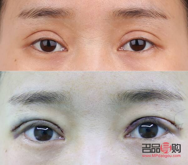 開眼角加割雙眼皮要多少錢(開眼角加割雙眼皮要多少錢費用)