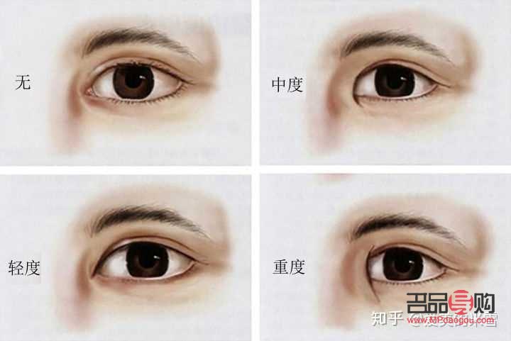 開眼角加割雙眼皮要多少錢(開眼角加割雙眼皮要多少錢費用)